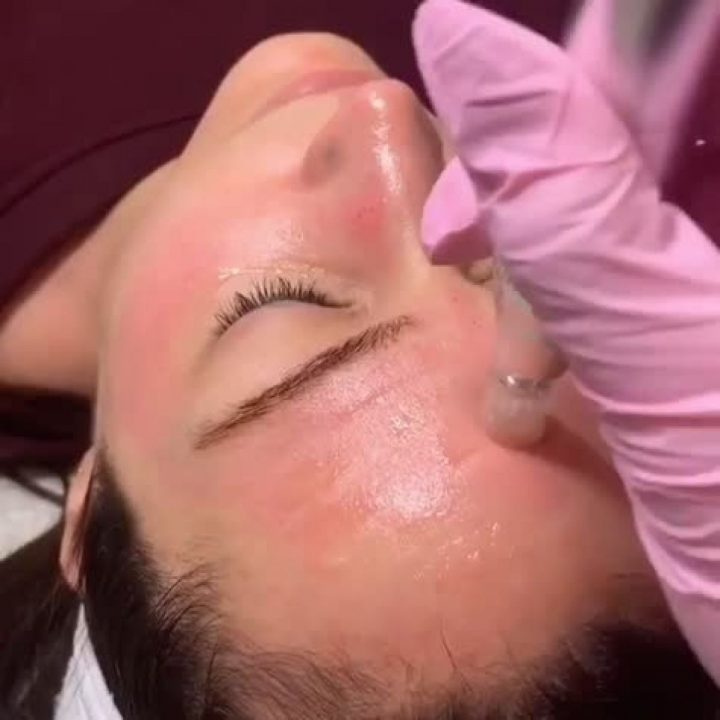 Microneedling Bb Glow À Marseille (13) Par Laetitia – Estheca dedans Estheca Marseille Avis