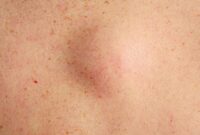 breast cancer armpit lump