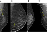 breast cancer margins guidelines