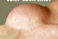 breast cancer armpit lump pictures