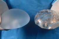 breast cancer reconstruction implants