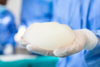 breast implant removal photos