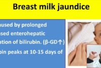 breastfeeding jaundice treatment