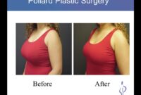 breast implant removal and lift