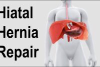 general surgery hiatal hernia repair