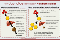 breastfeeding jaundice timeline