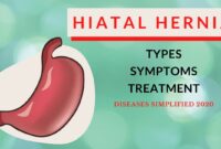 youtube hiatal hernia surgery