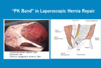 latest news from hernia surgery