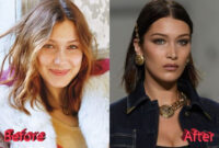 bella hadid before and after surgery