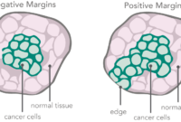 what are clear margins in breast cancer
