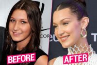 did bella hadid get surgery