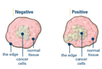 clear margins in breast cancer