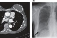 breast implant complications after 10 years