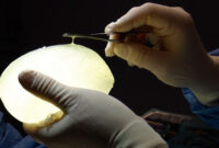 breast implant surgeons in rochester ny