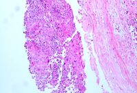 metaplastic breast cancer pathology outlines